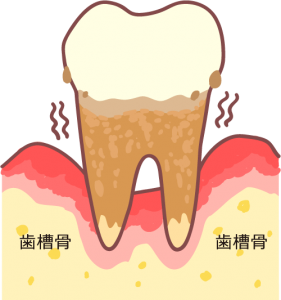 歯周病　歯槽骨が溶ける